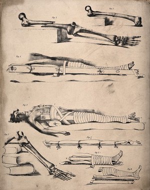 view Methods of bandaging a broken leg: eight figures, showing femur and tibia bones broken at various points and the appropriate methods of applying bandages and splints. Lithograph, 18--?.