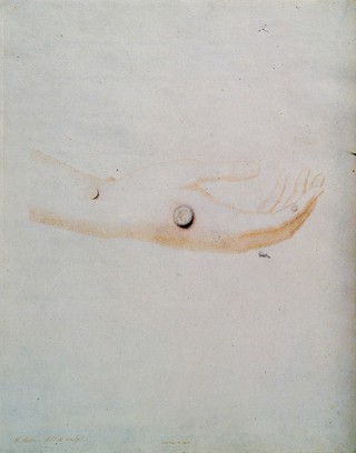 The hand of Sarah Nelmes with three cowpox pustules. Coloured etching by W. Cuff and W. Skelton after himself.