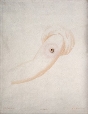 An arm with a vaccine pustule. Coloured etching by W. Cuff and W. Skelton after E. Pearce.