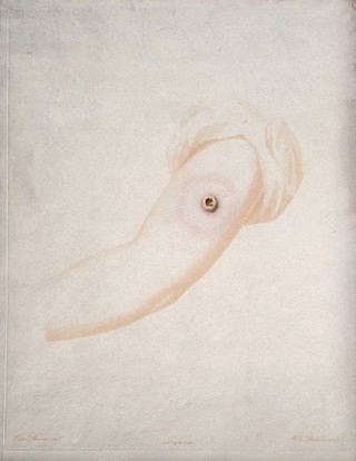 An arm with a vaccine pustule. Coloured etching by W. Cuff and W. Skelton after E. Pearce.