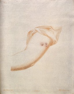 An arm with three smallpox pustules. Coloured etching by W. Cuff and W. Skelton after E. Pearce.