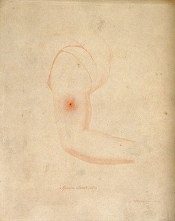 An arm with a vaccine pustule. Coloured etching by W. Skelton after himself.