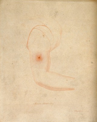 An arm with a vaccine pustule. Coloured etching by W. Skelton after himself.