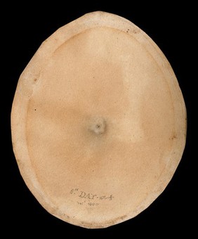 A smallpox pustule on the eighth day of the disease. Watercolour by W. Cuff, 1800.