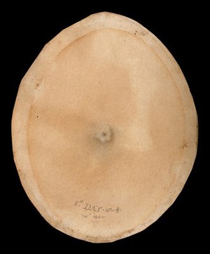 view A smallpox pustule on the eighth day of the disease. Watercolour by W. Cuff, 1800.