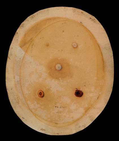 Cowpox pustules from the sixth to the eighteenth days of the disease. Watercolour by W. Cuff, 1801.