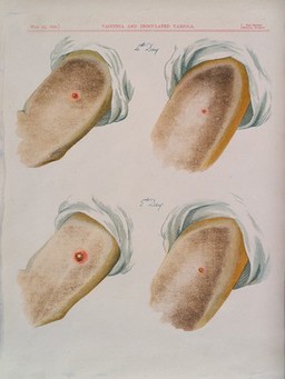 A comparison between smallpox and cowpox pustules on the 4th and 5th days of the disease. Chromolithograph, 1896, after G. Kirtland.