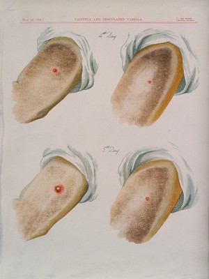 view A comparison between smallpox and cowpox pustules on the 4th and 5th days of the disease. Chromolithograph, 1896, after G. Kirtland.