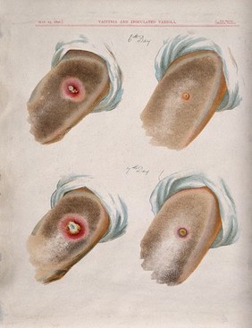 A comparison between smallpox and cowpox pustules on the 6th and 7th days of the disease. Chromolithograph, 1896, after G. Kirtland.