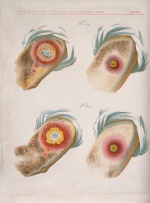 view A comparison between smallpox and cowpox pustules on the 10th and 11th days of the disease. Chromolithograph, 1896, after G. Kirtland.