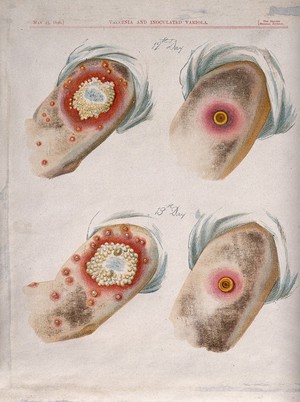 view A comparison between smallpox and cowpox pustules on the 12th and 13th days of the disease. Chromolithograph, 1896, after G. Kirtland.