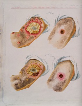 A comparison between smallpox and cowpox pustules on the 14th and 15th days of the disease. Chromolithograph, 1896, after G. Kirtland.