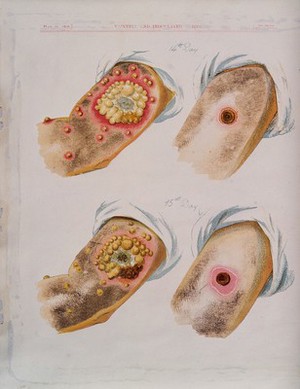 view A comparison between smallpox and cowpox pustules on the 14th and 15th days of the disease. Chromolithograph, 1896, after G. Kirtland.