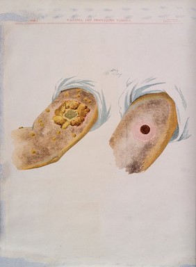 A comparison between smallpox and cowpox pustules on the 16th day of the disease. Chromolithograph, 1896, after G. Kirtland.