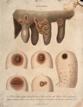 A cow's udder with vaccinia pustules and human arms exhibiting both smallpox and cowpox pustules. Coloured engraving by J. Pass, 1811.