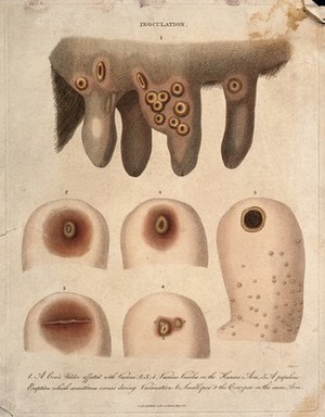 view A cow's udder with vaccinia pustules and human arms exhibiting both smallpox and cowpox pustules. Coloured engraving by J. Pass, 1811.