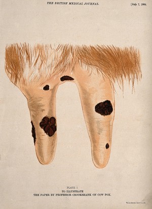 view A cow's udder with vaccinia pustules. Chromolithograph.