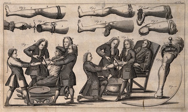 Amputations of arm and leg with diagrams to illustrate how to perform the operations. Engraving by F. Sesoni, 1749.