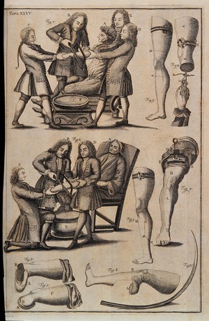 view Amputations of arm and leg with diagrams to illustrate how to perform the operations. Engraving, 1743.