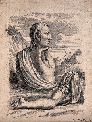 Samuel Wood, a man whose shoulder and arm were torn off in an accident at a mill. Engraving.