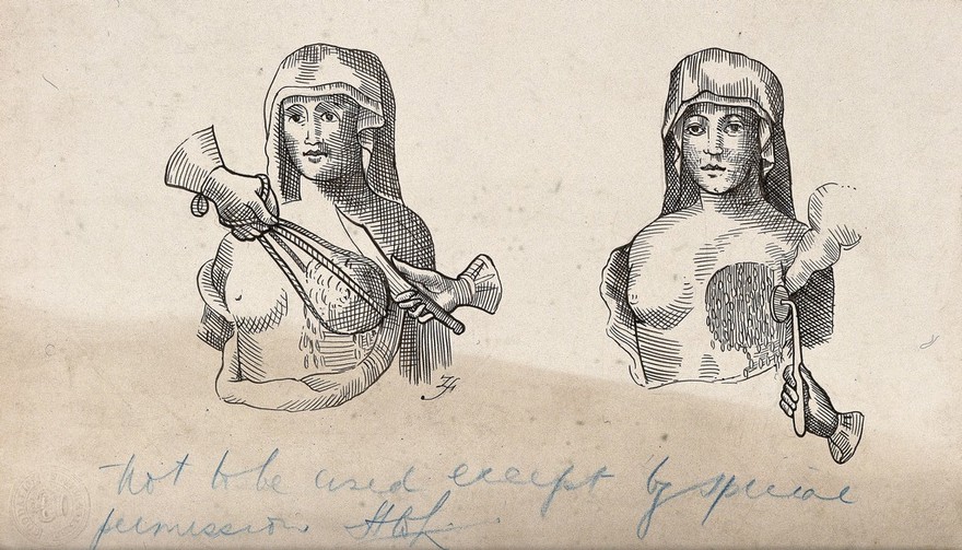 Diagrams illustrating how to perform a mastectomy and cauterise the wound. Pen drawing by ZS (?), 19--, after an engraving, 1603.