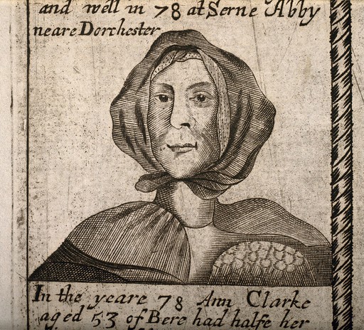 A woman aged 71 with breast cancer