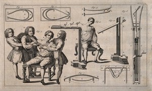 view A surgeon and two assistants manipulating dislocated shoulder back into the correct position and other diagrams of different methods of curing dislocation. Etching.