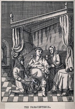 A surgeon performing a paracentesis on an obese man, whose swollen abdomen has a cannula inserted into it, and is subsequently releasing fluid into a basin. Pen drawing by Z.S. after an engraving, 1672.