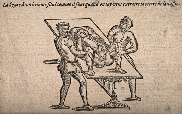 A male patient on a table being held in the lithotomy position by two assistants. Woodcut, 1628.