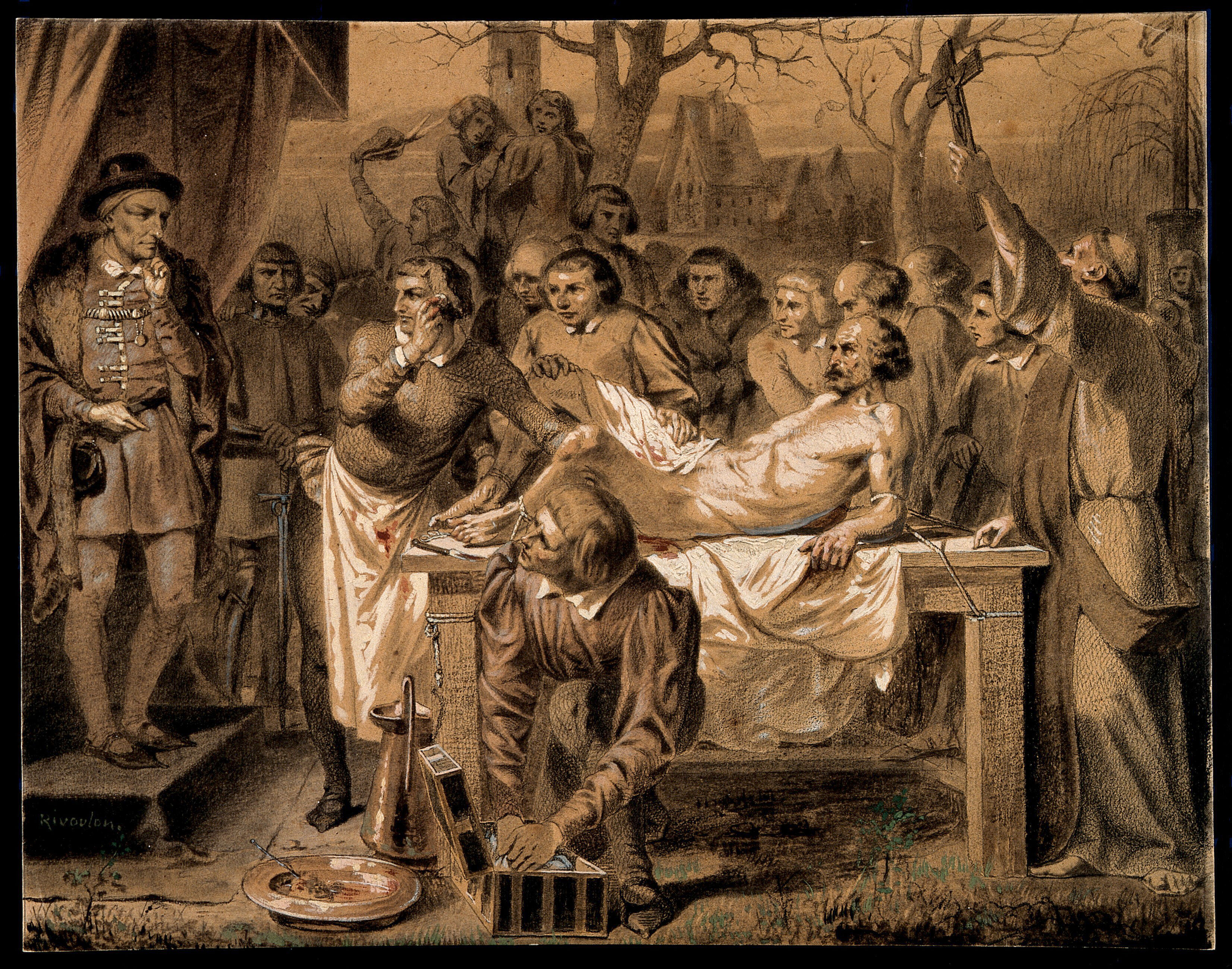 Germain Colot Performing An Operation For Bladder Stone Coloured