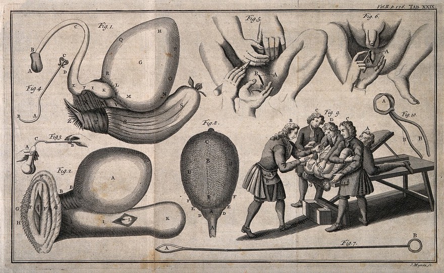 A surgeon performing a lithotomy on a patient who is being restrained by three assistants, with five other anatomical illustrations. Engraving by J. Mynde.