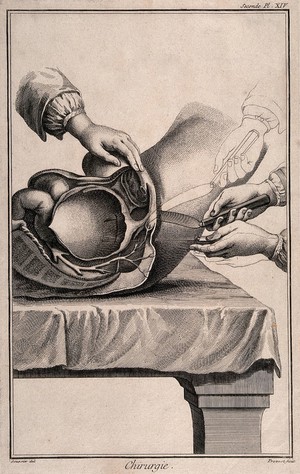 view A lateral incision into the hypogastrium for removal of bladder stone. Engraving by B. Prevost after L.J. Goussier.