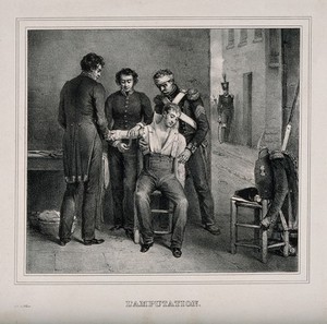 view A military surgeon amputating the arm of soldier in the open air. Lithograph by F. le Villain.