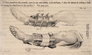 view Two diagrams of legs in splints, illustrating how to set a fractured limb. Stipple engraving by D. Lizars after J. Bell.