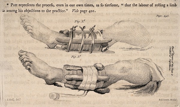 Two diagrams of legs in splints, illustrating how to set a fractured limb. Stipple engraving by D. Lizars after J. Bell.