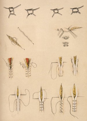 view Surgical stitches and knots. Coloured pencil drawing.