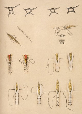 Surgical stitches and knots. Coloured pencil drawing.