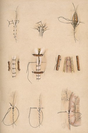 view Surgical stitches and the tying-up of wounds. Coloured pencil drawing.