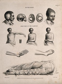 Abnormal heads and skulls, fractured and bandaged clavicle and a broken (?) leg bandaged in a splint. Engraving by W. Lowry, 1811, after J. Farey, the younger.