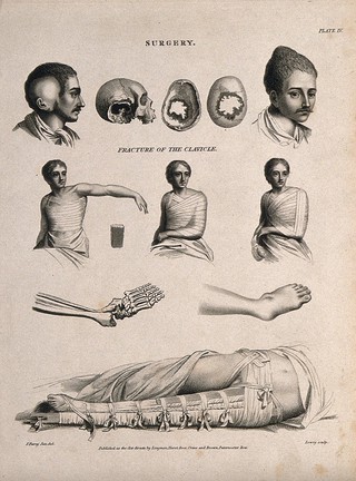 Abnormal heads and skulls, fractured and bandaged clavicle and a broken (?) leg bandaged in a splint. Engraving by W. Lowry, 1811, after J. Farey, the younger.