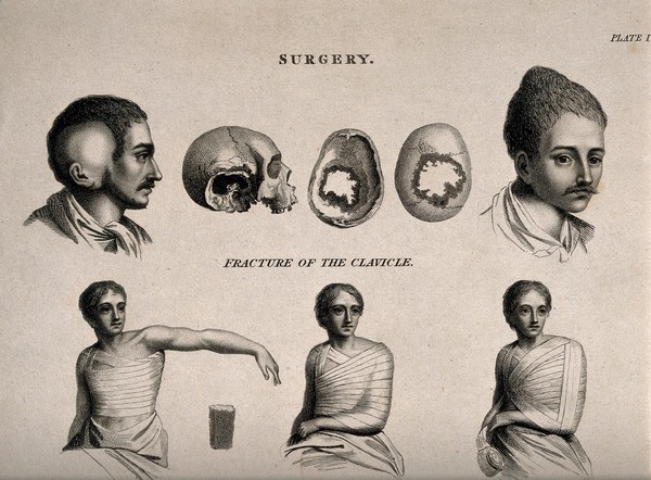 Abnormal heads and skulls, fractured and bandaged clavicle and a broken (?) leg bandaged in a splint. Engraving by W. Lowry, 1811, after J. Farey, the younger.