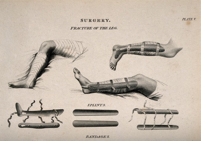 Diagrams illustrating: bandaged legs in splints, bandaged upper bodies and bandaged heads and eyes. Engraving by W. Lowry, 1811, after J. Farey, the younger (?).