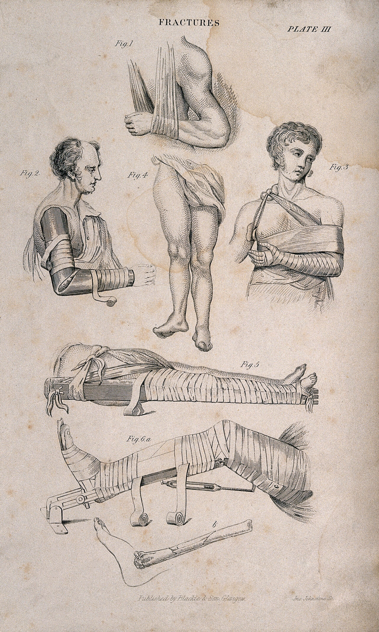 Diagrams illustrating how to bandage and set fractures in splints. Engraving by J. Johnstone., by John Johnstone
