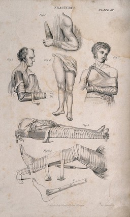 Diagrams illustrating how to bandage and set fractures in splints. Engraving by J. Johnstone.