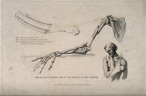 view Diagrams illustrating how to set a broken arm. Stipple engraving.