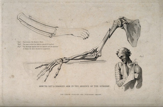 Diagrams illustrating how to set a broken arm. Stipple engraving.