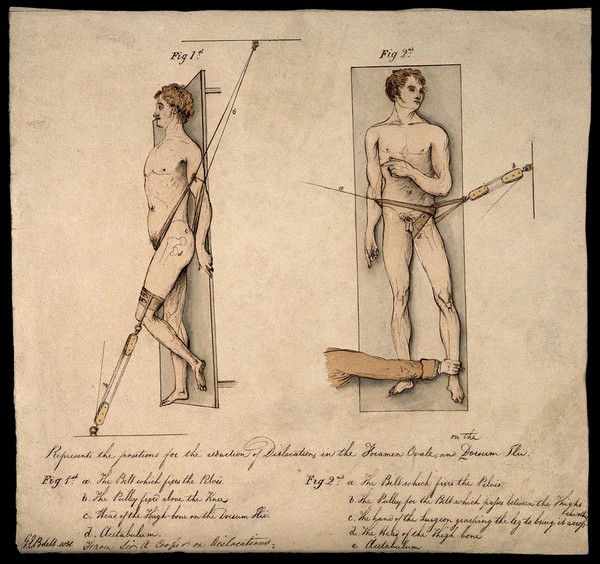 Two human figures illustrating the reduction of dislocations of the foramen ovale and the dorsum ilii. Coloured pen drawing by G.E. Blenkins, 1831.