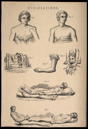 Seven illustrations of reducing various dislocations. Process print.