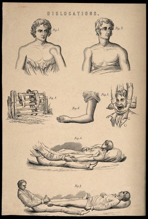 view Seven illustrations of reducing various dislocations. Process print.