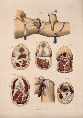 Cross-sections through the knee. Coloured lithograph by M. Hanhart after C. Heath after J.B. Léveillé.